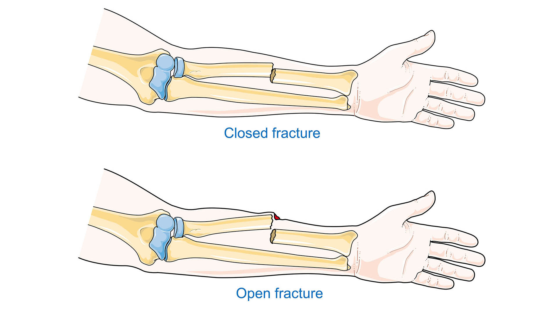 Le fratture possono essere chiuse o esposte, composte o scomposte. Tutte possono essere complicate da lesioni dei vasi e dei nervi e interessate da edema (gonfiore) e in seguito ecchimosi per il versamento di sangue nei tessuti